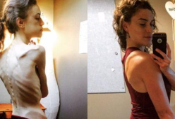 Una 20enne sconfigge l’anoressia e rivela: "Instagram mi ha salvato la vita"
