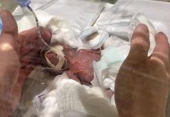 Il neonato più piccolo del mondo ce l'ha fatta: ecco quanto pesava