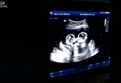 Gemelline giocano nella pancia della mamma: l’ecografia dolcissima