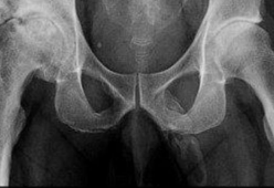 Fa una lastra e scopre che il suo pene stava diventando un osso
