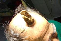 Quest'uomo indiano aveva uno spaventoso corno in testa