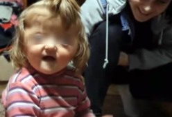 Bambina non ammessa a scuola per una malformazione al cranio
