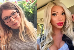 21enne ossessionata dalla chirurgia estetica: la trasformazione