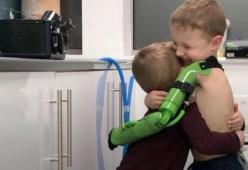 Bimbo nato senza un arto può finalmente abbracciare il fratello con un braccio bionico