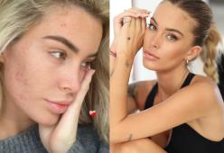 Sophie Codegoni si mostra senza filtri e con l'acne sui social

