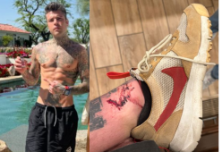 Fedez a LA e l'infortunio alla caviglia: "Rotolato dalle scale"