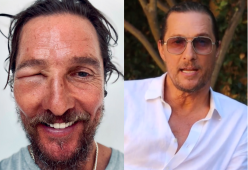 Matthew McConaughey punto da un’ape: il selfie spaventa i fan