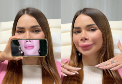 Influencer scioglie il filler alle labbra: “Diventerò un mostro”