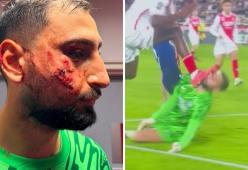 Donnarumma, infortunio choc in Ligue 1: 10 punti di sutura al volto