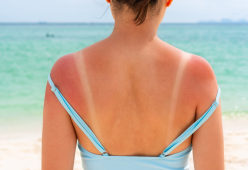 La sfida su TikTok che rovina la pelle: cos’è la Sunburn Challenge