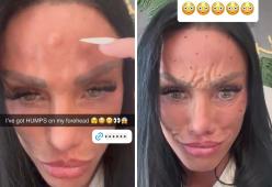 Viso con effetto “gobbe”: il selfie dopo il trattamento botox