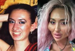 Guance più grandi al mondo: la modella racconta la trasformazione