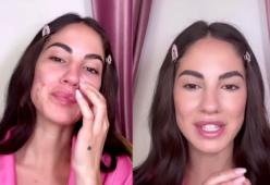 Giulia De Lellis combatte con l’acne: “Ho avuto uno sfogo tremendo”