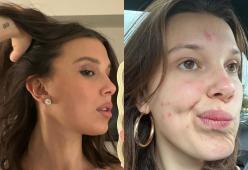 Millie Bobby Brown mostra sui social il viso segnato dall’acne