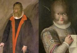 La Bella e la Bestia è la storia vera di un uomo con una rara malattia