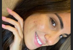 Giulia De Lellis senza filtri posta le foto del suo volto con l'acne