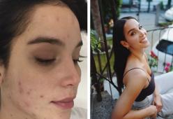 Paola Di Benedetto mostra il viso coperto dall'acne e racconta il suo problema ai fan