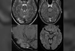 Ha l'emicrania da 7 anni: le trovano una cisti piena di vermi nel cervello