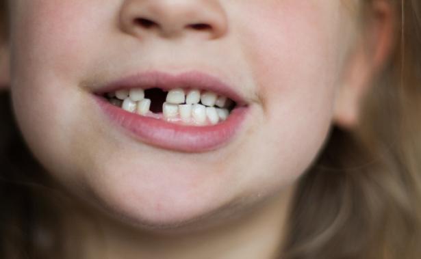 Denti che cadono